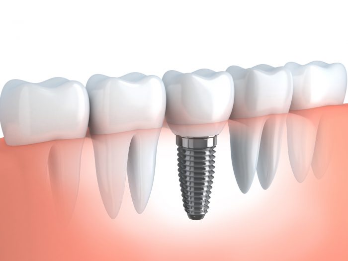 where can i find the best dental implants in tampa fl?