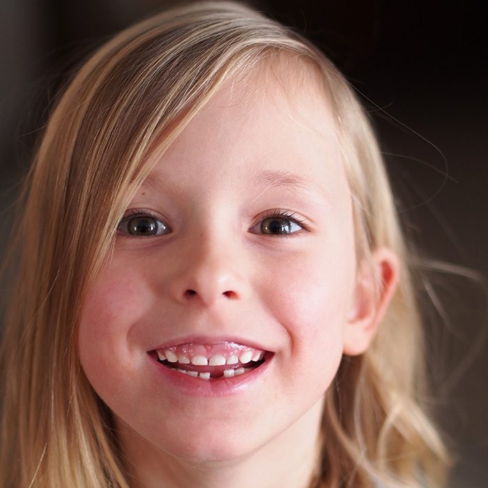 Girl Smiling and missing tooth.