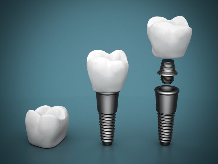 where can i find the best implant dentist in tampa fl near me?